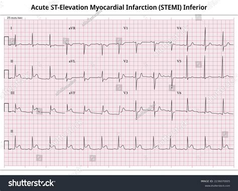 Inferior Infarction Ecg