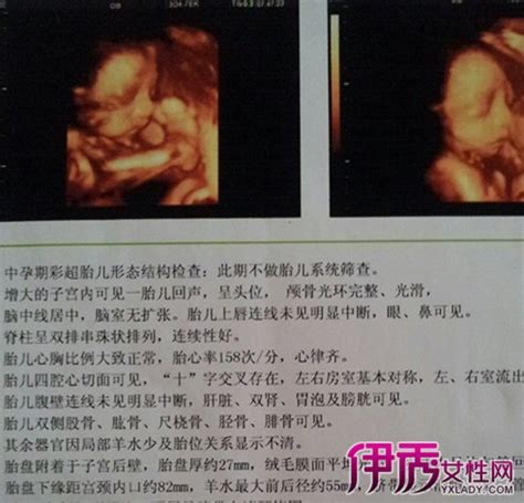 两次胎停之后做第三代试管婴儿成功生下胞胎男孩-莱婴健康