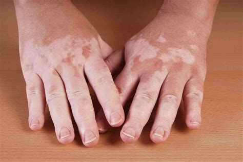 Does consuming milk with fish or salt cause white patches on skin-
