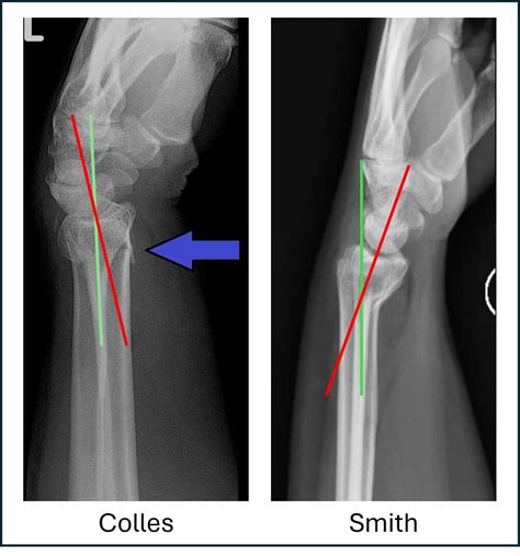 Distal Radial Fractures - Scrub Book