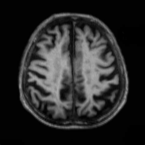 Do Alzheimer's Plaques Show Up On Mri at Troy Cason blog