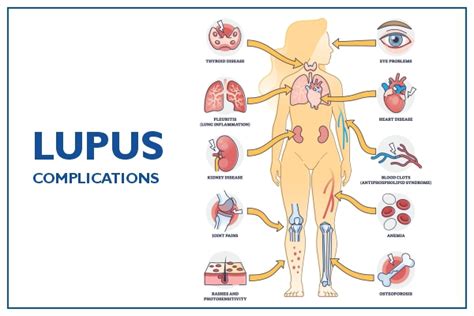 Lupus: Symptoms, Dos and Don’ts,Causes & Risks, Treatment | Medicover
