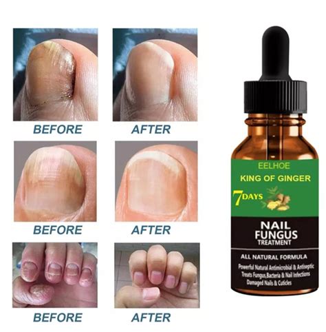 Under Nail Fungus Home Remedies