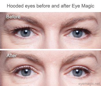 hooded eyelids | Eye Magic Eyelid Lift Blog | Droopy eyelids, Makeup ...