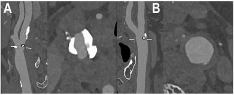 Dual Source Photon-Counting Computed Tomography—Part II: Clinical ...