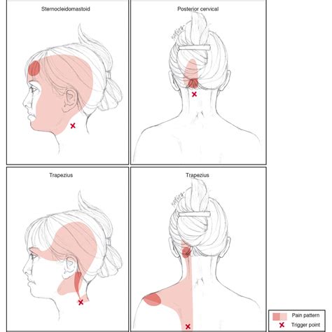 Trigger Point Chart Head And Neck at Fred Rollins blog