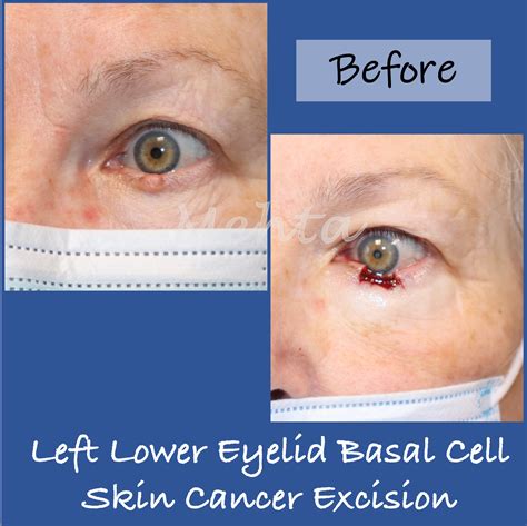 Facial Nerve Damage After Mohs Surgery at Marlene Boyd blog