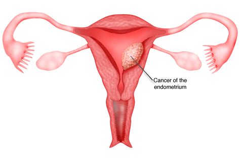 Chapter 12 – Cancer of the Endometrium – Melaka Fertility