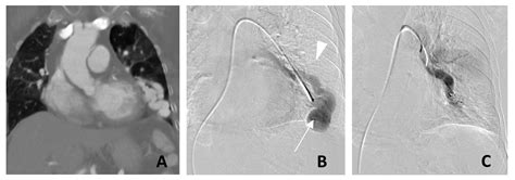 The Role of Interventional Radiology in the Diagnosis and Treatment of Pulmonary Arteriovenous ...