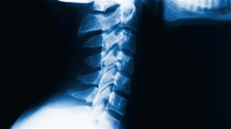 Cervical Lordosis - What is It and Why is It Important?