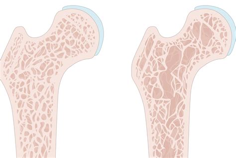 Trabecular Bone Score Plus BMD Improves Identification of Abnormal Bone in Women With Fracture ...