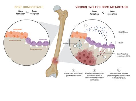 Bone Cancer Cells