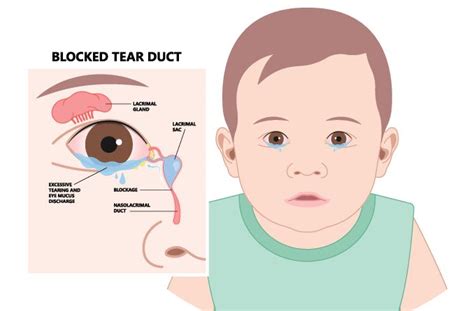 انسداد مجاري اشك blocked tear ducts in infant and toddlers