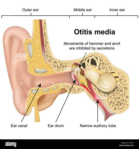 Otitis Media