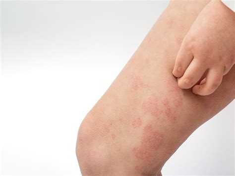 What Causes Acne, Plus Breakout Treatment & Prevention | AVEENO®