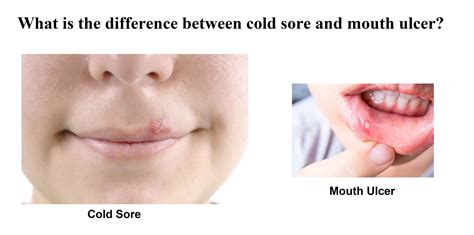 Cold Sores Vs Canker Sores