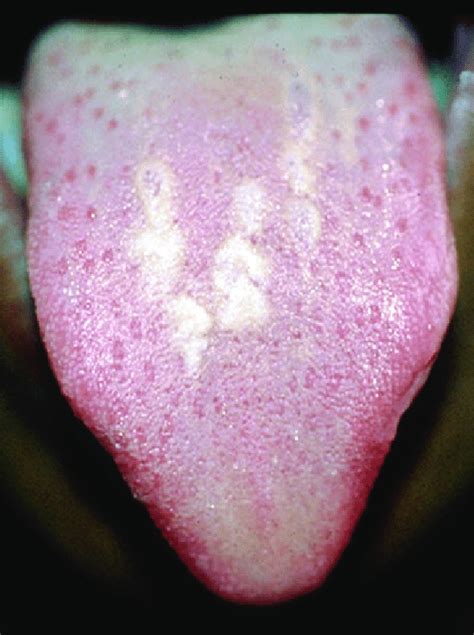 13 oral candidiasis-white plaque on the tongue | Download Scientific ...