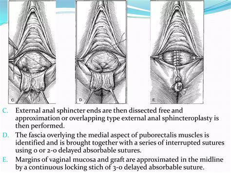 Perineal lacerations | PPTX
