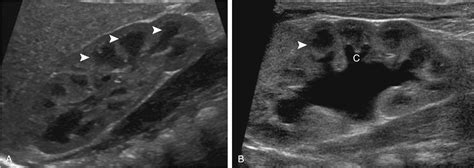 Imaging Approach to Urinary Tract Dilation - Clinical Tree