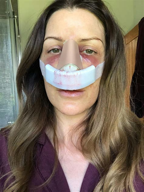 Rhinoplasty swelling: The stages of recovery | MYA Cosmetic Surgery