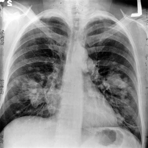 🎗 Layer X-ray detects lung cancer in time