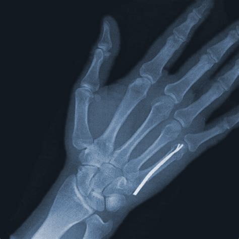 Spiral Fracture Finger Healing Time