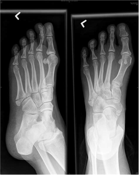 Lateral foot pain following open reduction and internal fixation of the ...