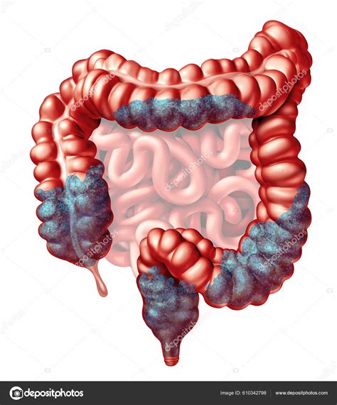 Constipation Anatomy Constipated Symptoms Stool Bowel Movement Problem Intestine Rectum — Stock ...