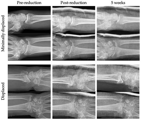 Prospective Evaluation of Two Cohorts of Non-Operatively Treated ...