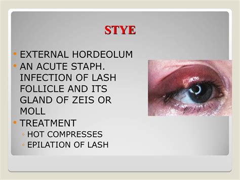 INFLAMMATION & INFECTIONS OF EYELIDS.ppt