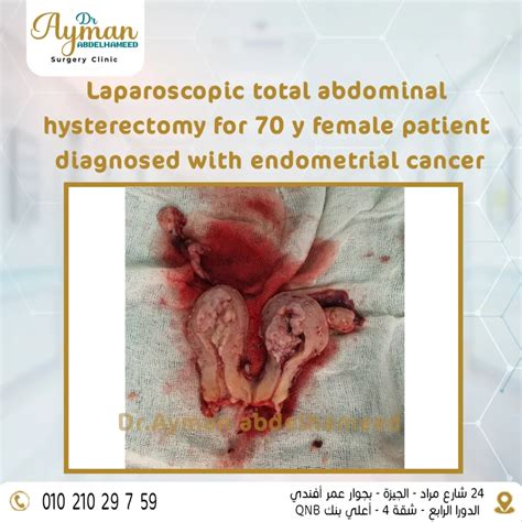 Laparoscopic total abdominal hysterectomy - Dr.Ayman Abd Elha
