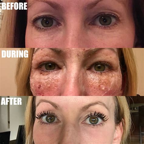 the stylish housewife CO2 Laser before and after Archives - the stylish housewife