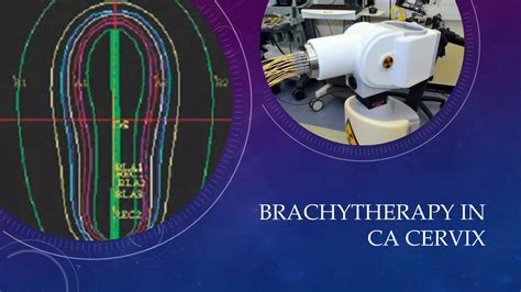 Brachytherapy in Carcinoma Cervix | PDF