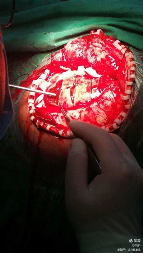 慢性硬膜下血肿钻孔引流术后复发，再次行开颅慢性硬膜下血肿清除术的病例分享