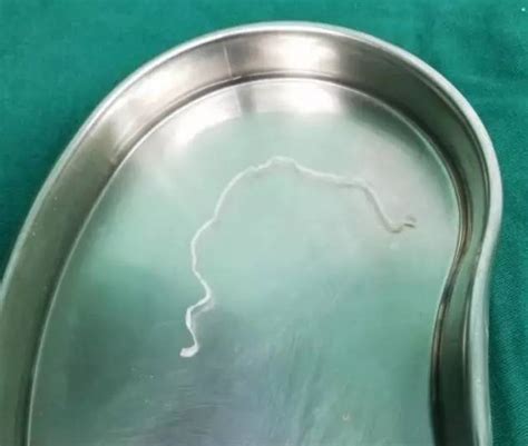 广东医生从女孩头部取出25厘米寄生虫，它已寄生6年，有专属“隧道”！