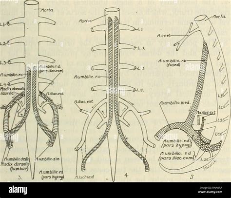 . The Anatomical record 1922-1923. Anatomy. SINGLE rMBILICAL ARTERY IN HUMAN FETUSES 329 ...