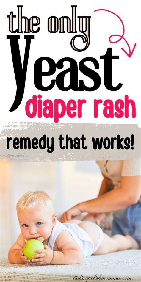 diaper rash natural remedies