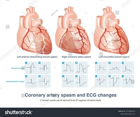Coronary Artery Spasm Causes Transmural Myocardial Stock Illustration 2172864671 | Shutterstock