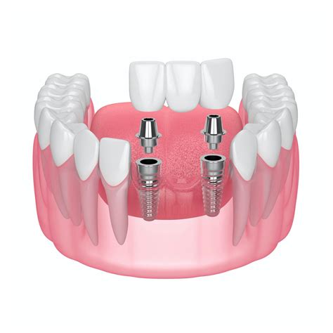 Dental Bridge Mesa, AZ - Las Sendas Dental Health