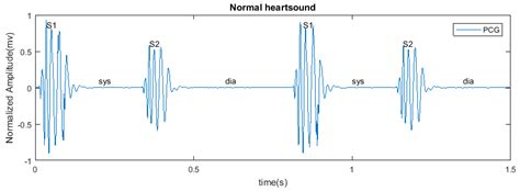 Heart Sounds Diagram S1 S2