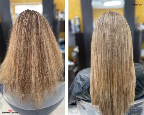 Botox For Hair: Do Botox Scalp Injections Promote Hair Growth?