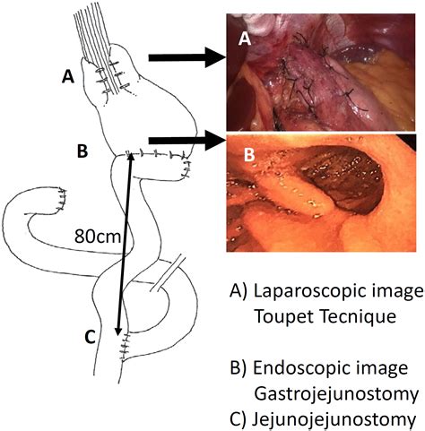 Toupet Fundoplication
