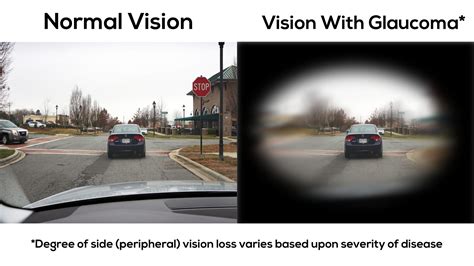 Legally Blind Vision