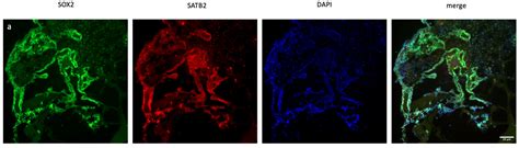 Role of Long Non-Coding RNA X-Inactive-Specific Transcript (XIST) in ...