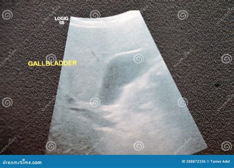Ultrasound of the Gall Bladder Showing Normal Size, with Average Wall Thickness, with No Stones ...