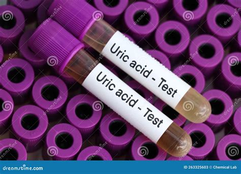 Uric Acid Test To Look for Abnormalities from Urine, Urine Sample To Analyze in the Laboratory ...