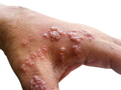 Herpes Skin Rash: हर्पीस स्किन रैश की समस्या क्या है? जानिए इसके लक्षण ...