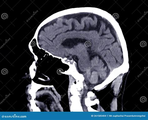 CT Scan of the Brain Sagittal View for Diagnosis Brain Tumor,stroke Diseases and Vascular ...
