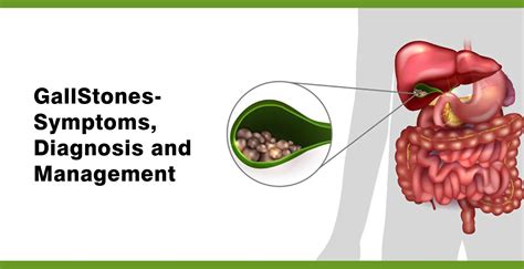 Gallstones: Symptoms, Diagnosis, and Management