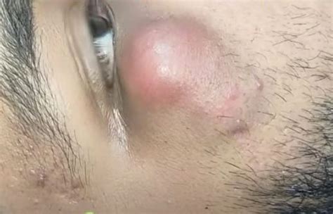 Image result for Abscess Explosion